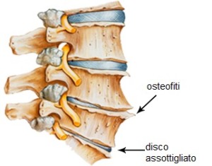 osteofiti sprain strain